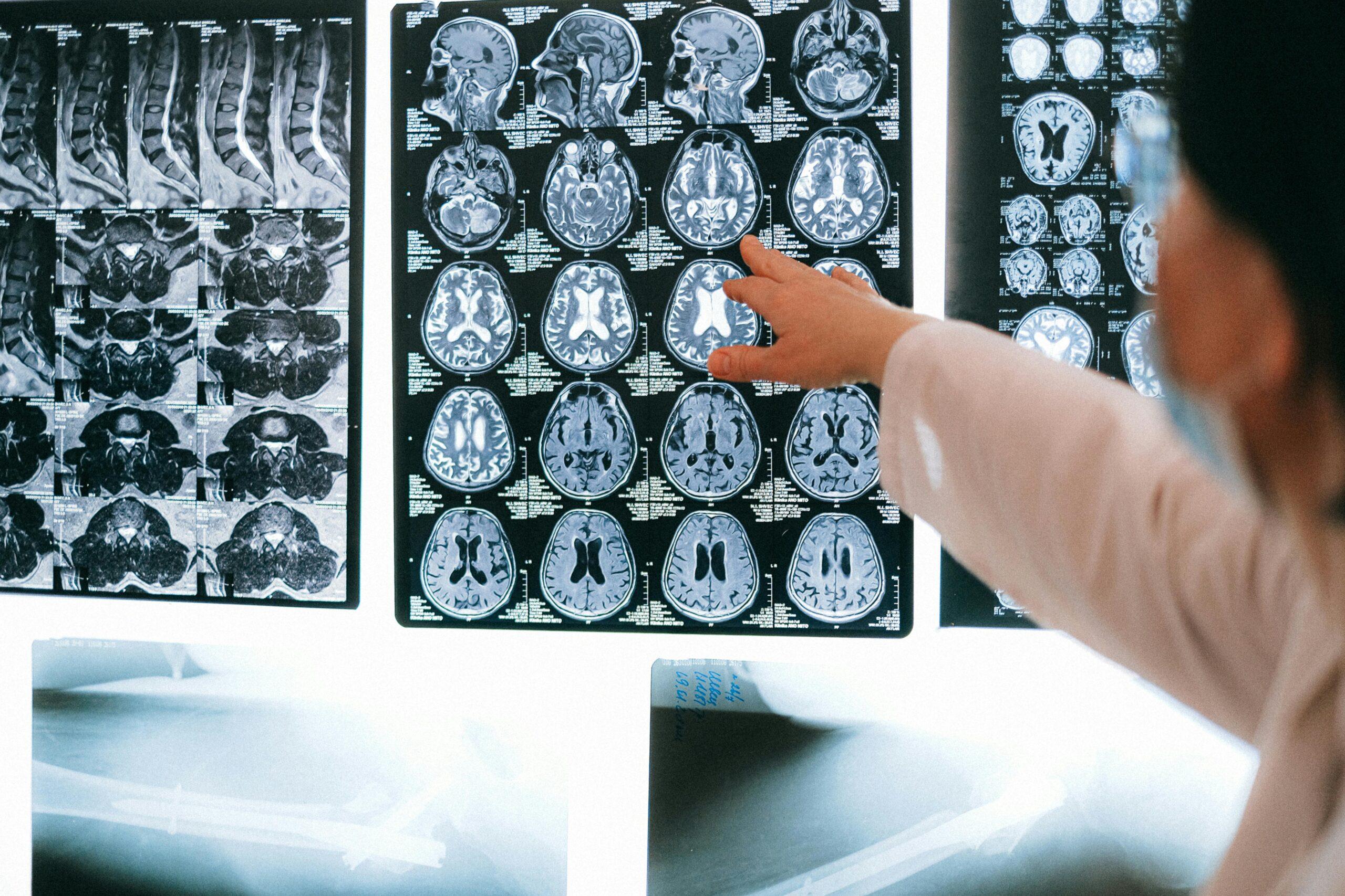 Traumatic Brain Injury